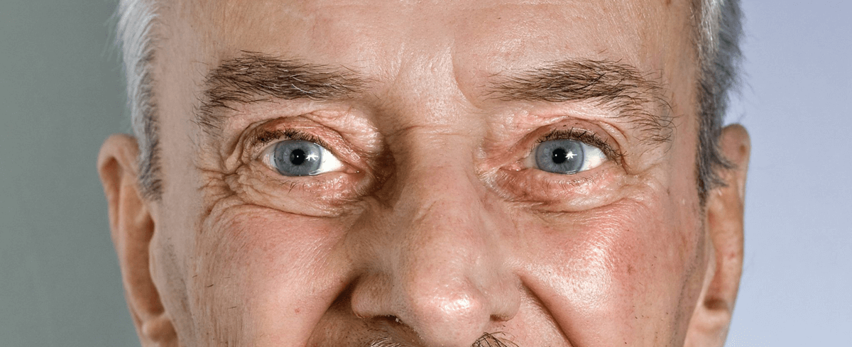 O que é a Catarata?