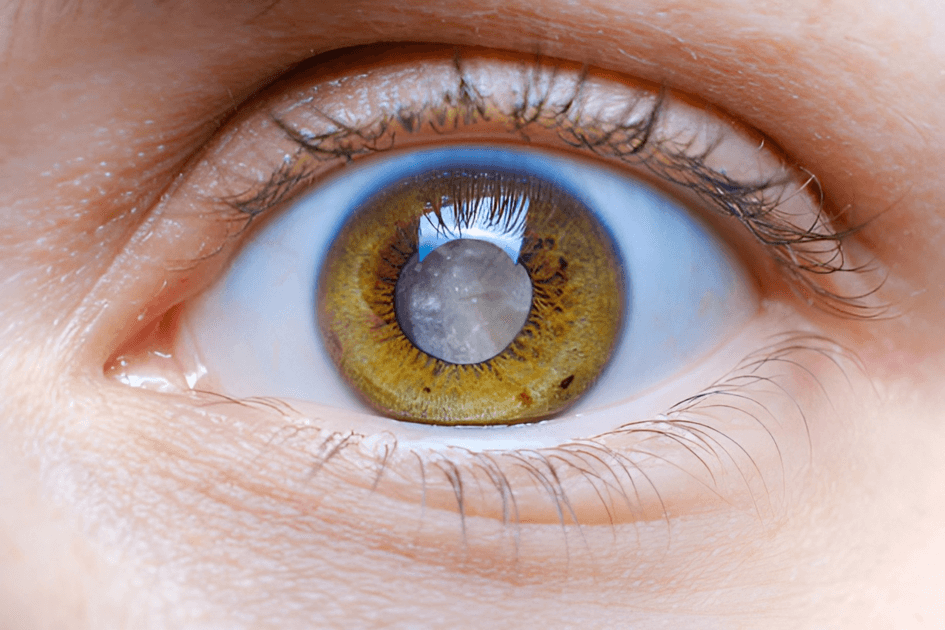 ¿Qué son las cataratas? ¿Las puedo prevenir?
