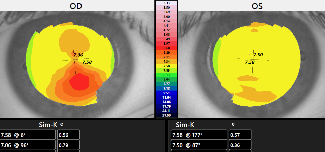 Topografía Corneal